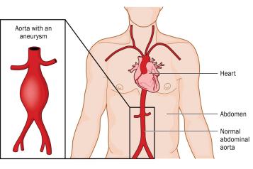 Abdominal aortic aneurysm screening