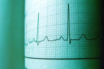 Photo of an ECG printout of a heartbeat